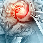 A 3D illustration of a blood clot in the vessels of the human brain.